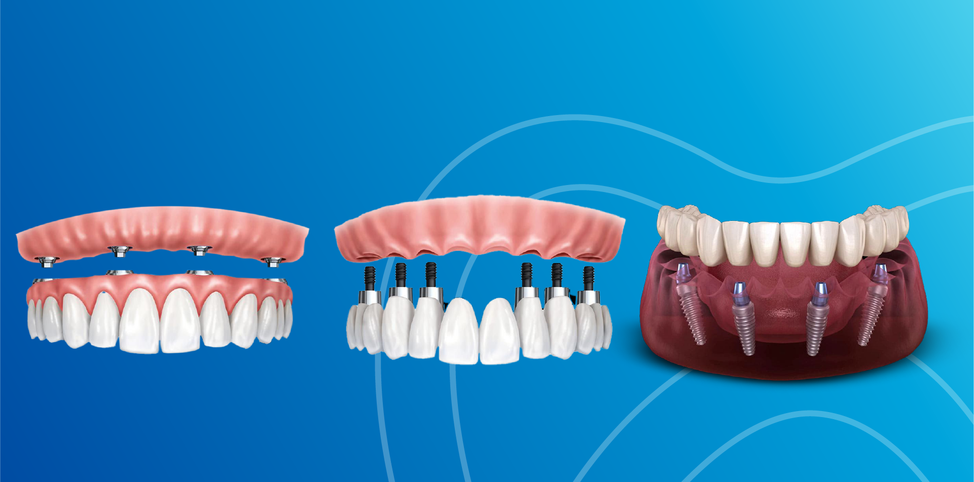 Antalya ALL ON 4 Dental clinic antalya