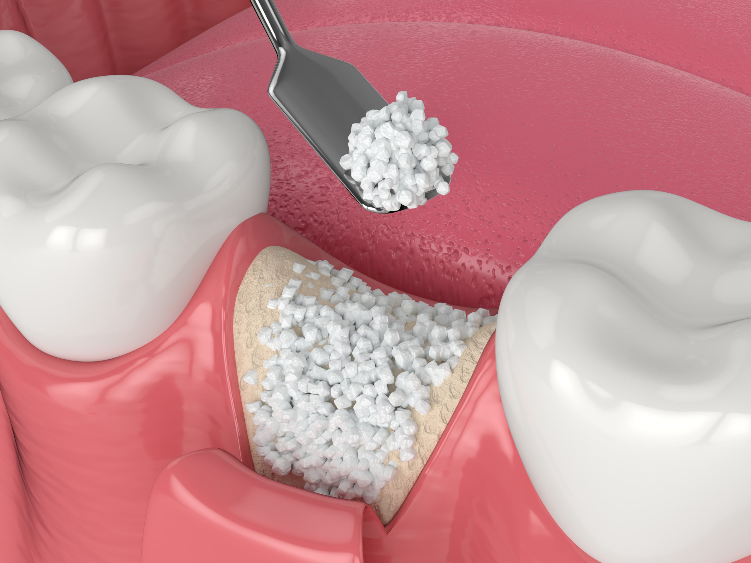 Antalya BONE GRAFTING antalya dental hospital