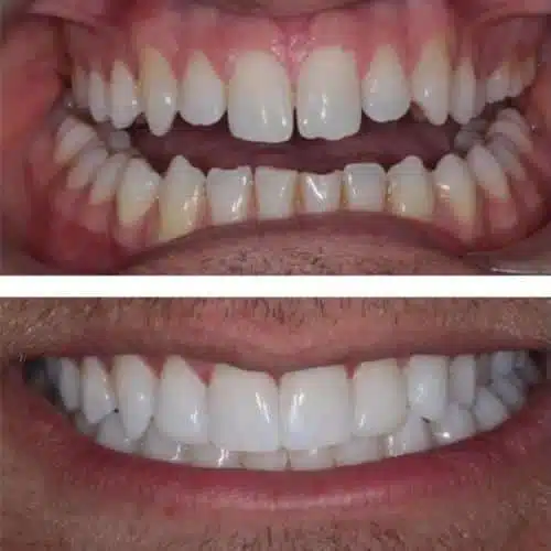 Antalya Composite Bonding clinic dental antalya