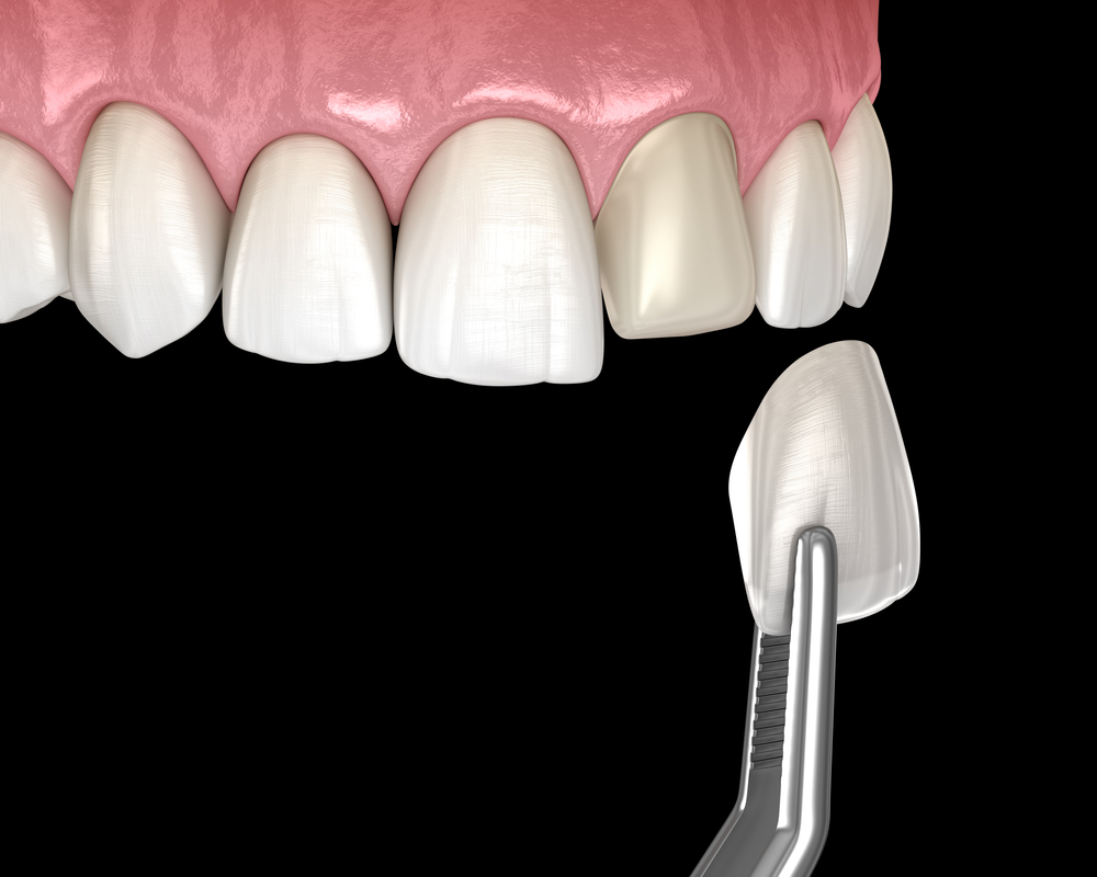 Antalya DENTAL VENEERS Clinic Antalya dentist