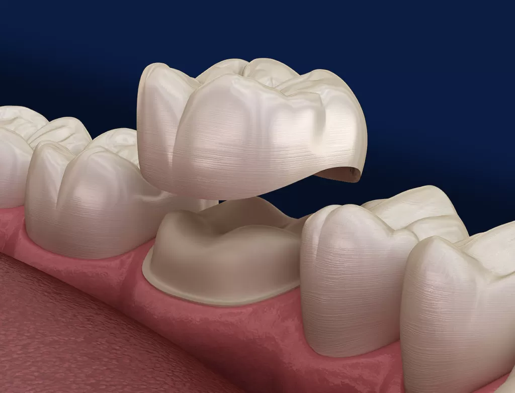 Antalya Dental crowns antalya dental clinic hospital