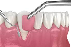 Antalya GUM GRAFT SURGERY Antalya clinic dental
