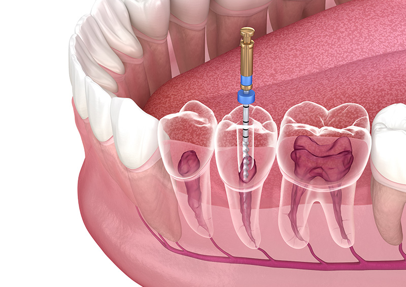 Antalya Restorative Endodontics antalya dental clinic Dentist