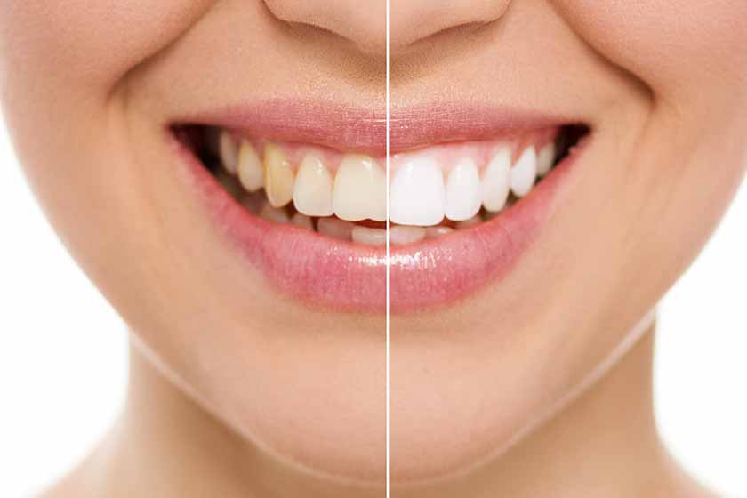ANTALYA TEETH WHITENING Clinic antalya dental