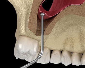 Antalya sinus lifting antalya dental clinic