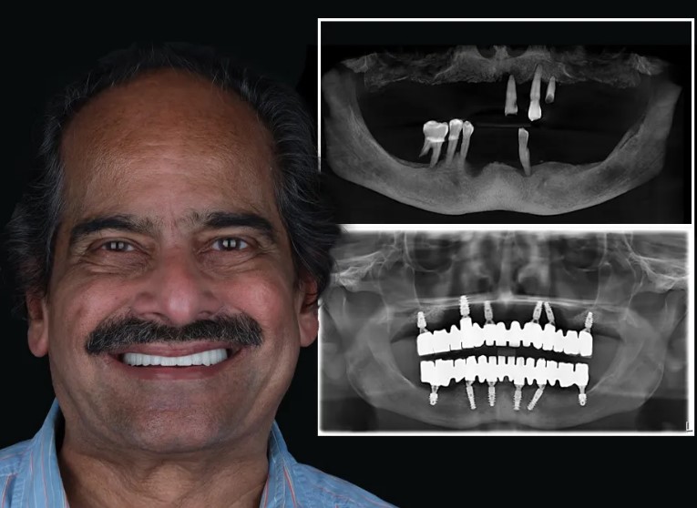 Aesthetic Dentures in Antalya