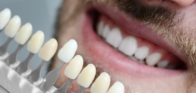 Composite-Teeth-Bonding antalya