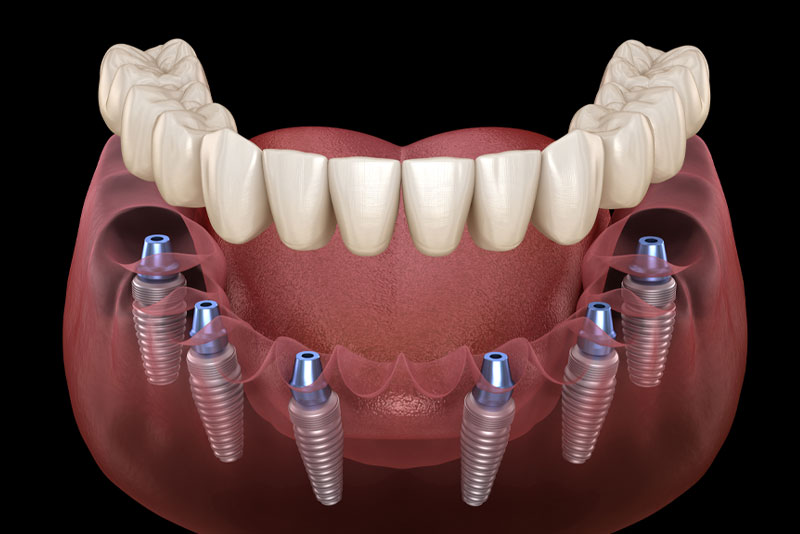 antalya full implants antalya dental clinic hospital
