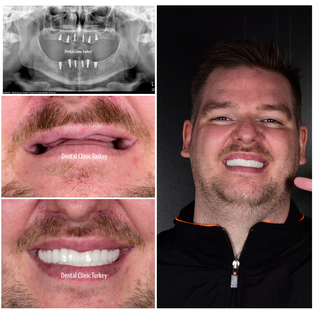 before-after all on 6 dental implant turkey antalya