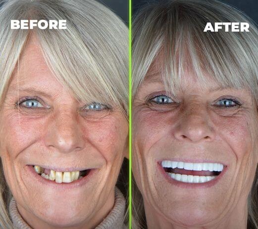 before-after-antalya all on 6 implants